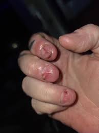 Image result for Onychotillomania feet