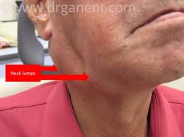 You appear panic when you come to know the deplorable name from the oncologist. Nose Cancer Screening Who Should Go For It Dr Gan Eng Cern