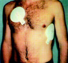 Image result for Transcutaneous Pacing