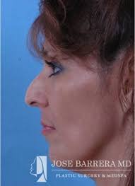 Top Rhinoplasty surgeon in San Antonio, TX