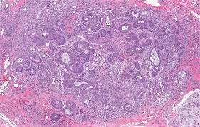 Maybe you would like to learn more about one of these? Pathology Outlines Necrotizing Sialometaplasia