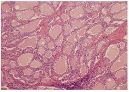 These antibodies activate the receptor, leading to development of a goitre and symptoms of hyperthyroidism, such as heat intolerance. View Of Conversion Of Primary Hypothyroidism To Hyperthyroidism A Case Report Journal Of The Asean Federation Of Endocrine Societies