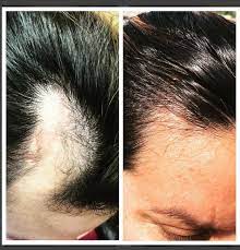 Does platelet rich plasma therapy work for hair loss? Hair Loss Treatment With Prp Hair Restoration Peabody Boston Ma