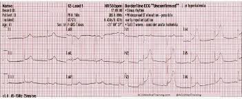 Image result for ST Elevation