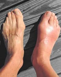 Image result for gout