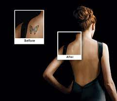 Does laser tattoo removal hurt? 1 Miami Laser Tattoo Removal Spa Picosure Laser