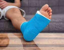 Image result for Short Leg Cast