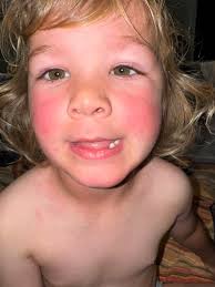 Sunscreen allergy in children, what to do?
