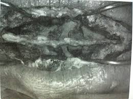 Presentamos el caso de una mujer de 34 años de edad con infección por vih que desarrolló una mucormicosis cutánea primaria necrótica relacionada con el uso de catéter. Mucormicosis Cutanea Presentacion De Caso Clinico Recuerdo De Etiopatogenia Diagnostico Y Tratamiento Revista De La Facultad De Ciencias Medicas De Cordoba