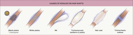 It may occur on the scalp, eyebrows, eyelashes, beard, axilla or in the groin. Fungal Diseases Plastic Surgery Key