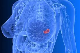 Different types of staging systems are used for different types of cancer. Key Genomic Differences In Breast Cancers Of Women Of Different Ethnicity