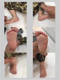 The ponseti casting technique is reported to have a high technique. Can Clubfoot Scoring Systems Predict The Number Of Casts And Future Recurrences In Patients Undergoing Ponseti Method Journal Of Orthopaedic Surgery And Research Full Text