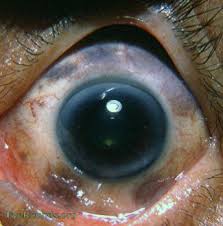 Image result for melanosis sclera