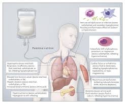 Image result for Refeeding Syndrome