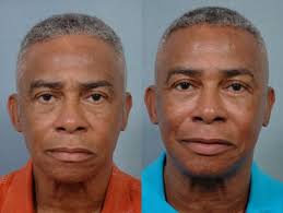 Monte Harris, MD, Board Certified Facial Plastic Surgeon