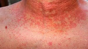 Image result for Scarlet Fever