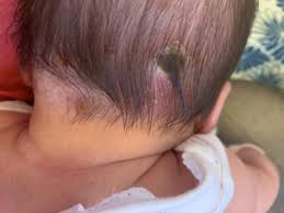 Image result for dry scabs on the head in children
