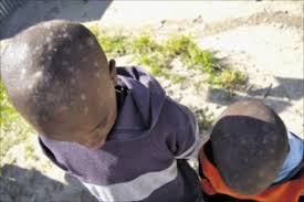 Image result for sores on the head in children