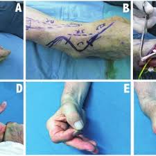 Opa at 10 days post op. A B Skin Incision C Br Tendon Was Followed Distally And Detached Download Scientific Diagram
