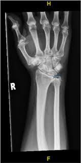 Ulnar Impaction Syndrome - Physiopedia
