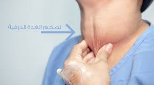 أعراض تضخم الغدة الدرقية ومعلومات هامة ويب طب