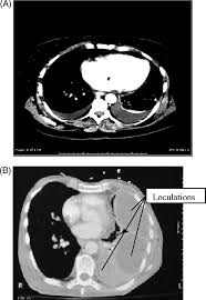 Pleural effusion is a condition in which excess fluid builds around the lung. Http Bjaed Org Article S1743 1816 17 30509 7 Pdf