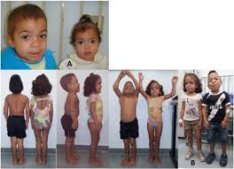Mucopolysaccharidosis Type Vi On Enzyme Replacement Therapy Since Infancy Six Years Follow Up Of Four Children Sciencedirect
