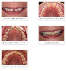 How long do lingual braces take? Invisible Lingual Braces Weston Super Mare Cosmetic Dentist