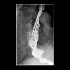 Mckeown esophagectomy is a surgical procedure to remove the esophagus and the upper portion of the stomach. Ivor Lewis Procedure Radiology Reference Article Radiopaedia Org