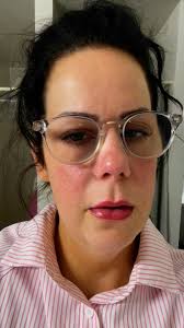 I have Ankylosing Spindelitus &...