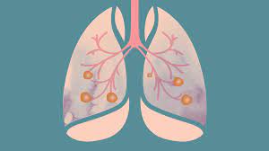 Because lung cancer develops in the lungs, as you'd probably expect, its most common symptoms involve the lungs. Remarkable Immunotherapy Trial Changes Advanced Lung Cancer Treatment