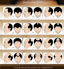 norwood scale chart new hair transplant methods