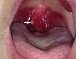 Image result for Epiglottitis