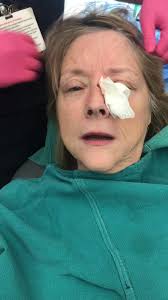 Well just had a MOHS surgery to remove a basal cell carcinoma off the ridge  of my nose. This is NOTHING compared to what I went through to beat SCC of  the