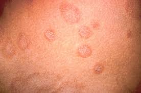 These include diphenhydramine (benadryl, others). Hautarztpraxis Dr Hempel Pityriasis Rosea