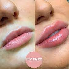 Lips of london aesthetics added a new photo to the album: Lip Fillers Treatment My Pure Aesthetic Clinic In London