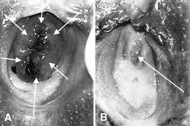 Image result for Urethral Prolapse