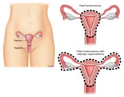 My lower back is killing me i have sharp pains where they went in i'm very bloated and nauseated half the time. Patient Education Vaginal Hysterectomy Beyond The Basics Uptodate