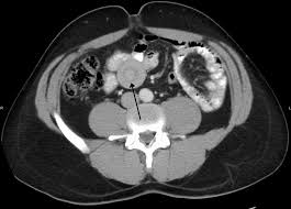 We did not find results for: Intussusception Medical Disorder Wikipedia