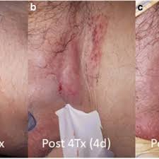 Image result for sore skin in the groin area