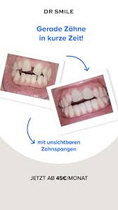 Garantiert Gerade Zahne In Kurzer Zeit Gerade Zahne Zahne Unsichtbare Zahnspange