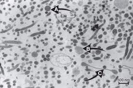 Scielo Brasil Description Of Lyme Disease Like Syndrome In Brazil Is It A New Tick Borne Disease Or Lyme Disease Variation Description Of Lyme Disease Like Syndrome In Brazil Is It A