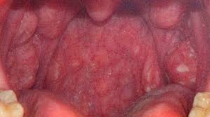 Image result for Strep throat infection roof of mouth
