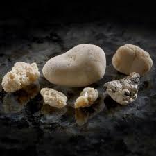 Medium Kidney Stones 5 20 Mm