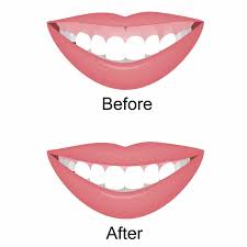 Please visit my smile care credit's website for more details on how to register. How To Fix A Gummy Smile Ultimate Guide To Gummy Smile Reduction