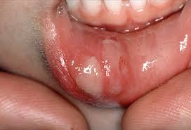 17 Mouth Tongue Problems Pictures Of Sores Blisters Bumps And More