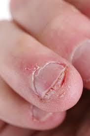Black dot on nail cuticle. Nail Abnormalities Causes Symptoms And Pictures