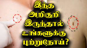 Stomach cancer is sometimes called gastric cancer. Throat Cancer Symptoms In Tamil Language Celine Dion Songs Age