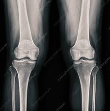 Image result for Knee XRay