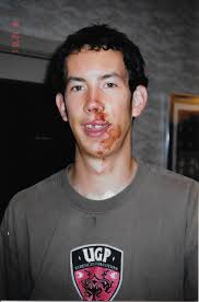 How Knocking Out My Teeth Led to My Career